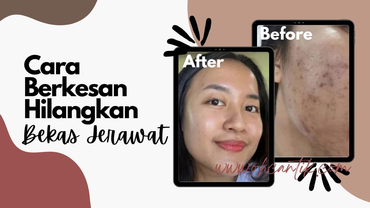 Cara Hilangkan Bekas Jerawat Degil Di Muka | Ohcantik.com