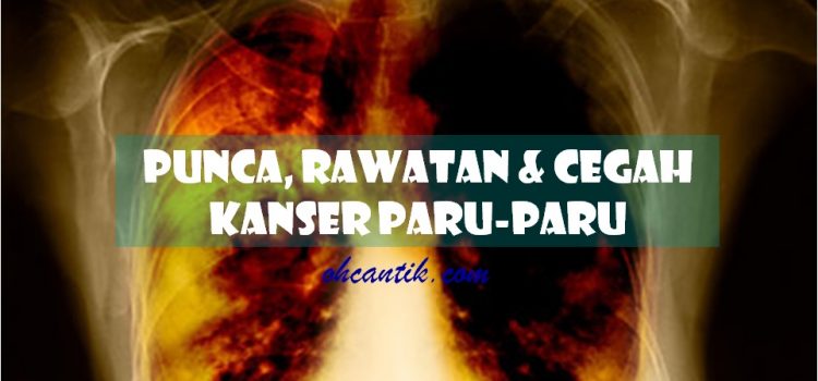 Punca Kanser Paru-paru: Rawatan & Pencegahan