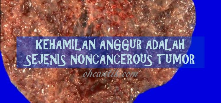 Kehamilan Anggur (molar pregnancy): Sejenis noncancerous tumor