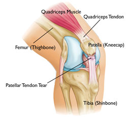 ubat sakit lutut