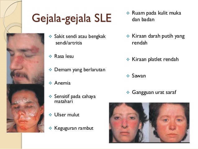 rawatan penyakit SLE