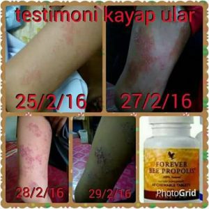 sembuhkan kayap